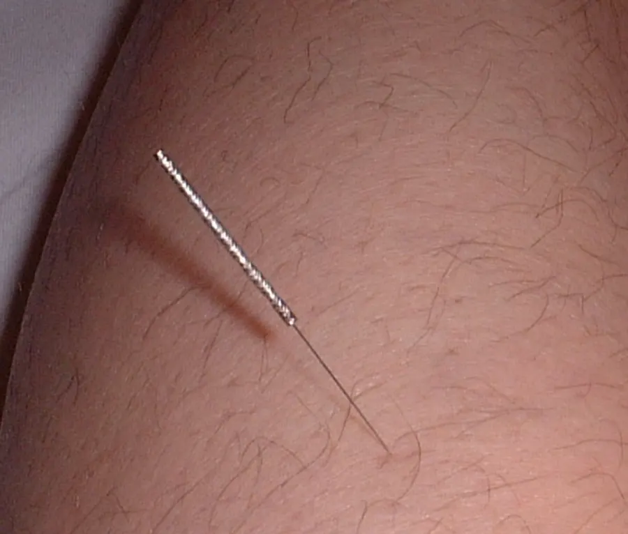 Acupuncture and Moxibustion — traditional medicine tradition