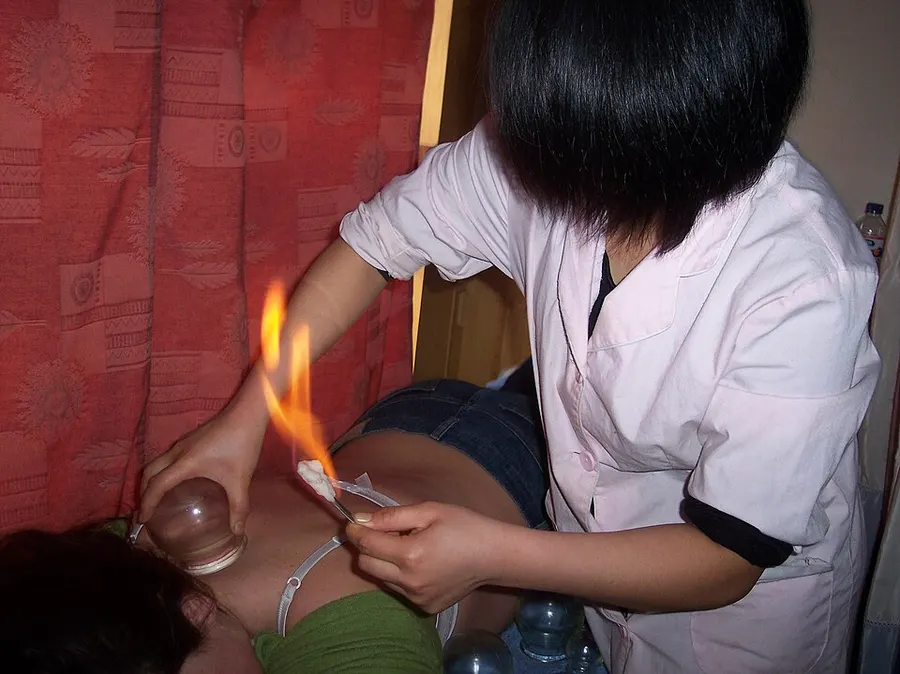 Cupping Therapy — traditional medicine archive piece