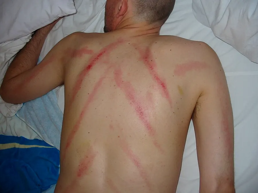Guasha Scraping Therapy — traditional medicine archive piece